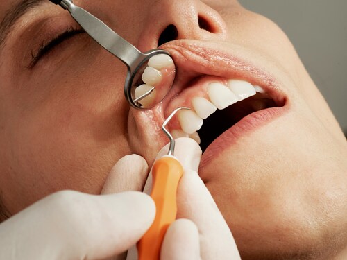 The Magic of Composite Bonding in London: A Smile Transformation